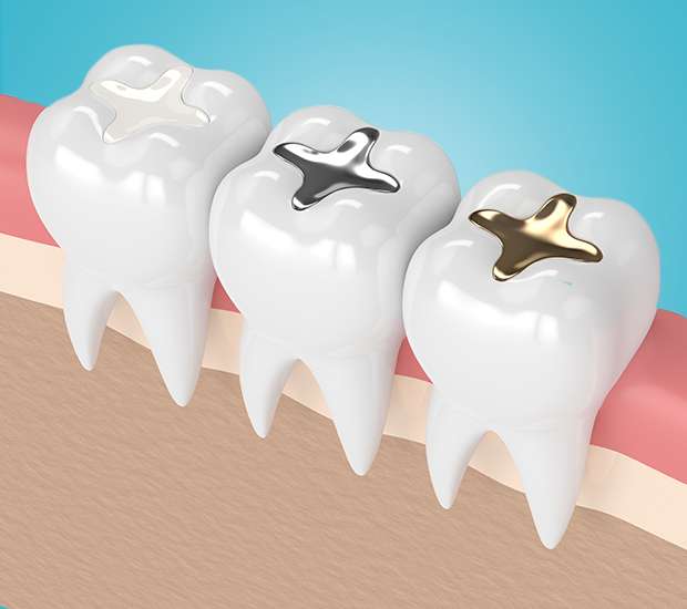 Cary Composite Fillings