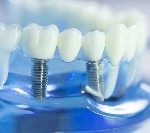 Cary Dental Implants