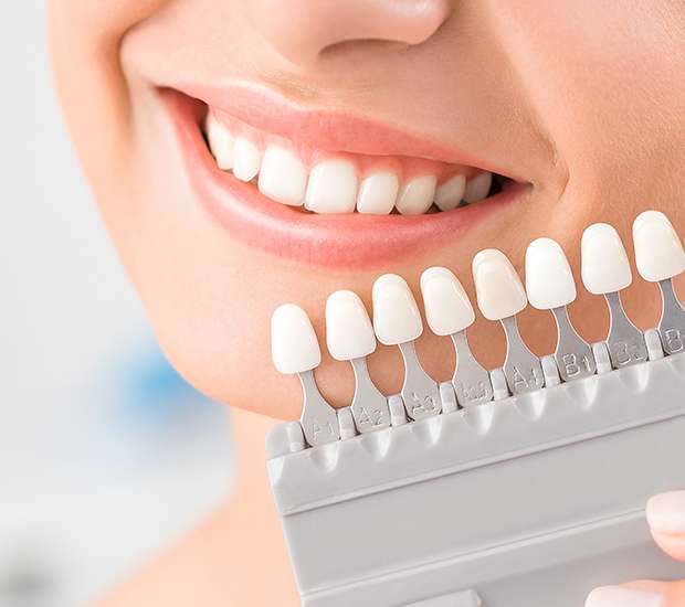 Cary Dental Veneers and Dental Laminates